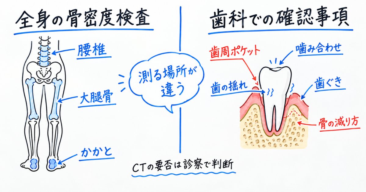 奥歯を残せるか：骨密度の数値より先に調べたいこと