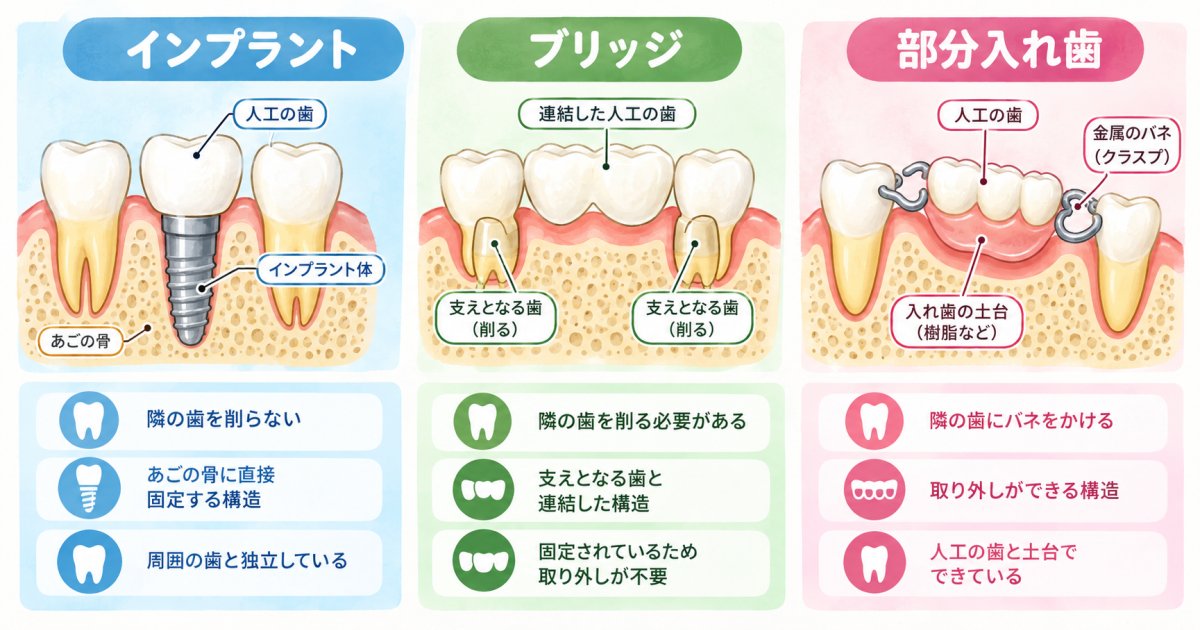 インプラント・ブリッジ・入れ歯を同じ物差しで見る：隣の歯、外科処置、通院、維持費